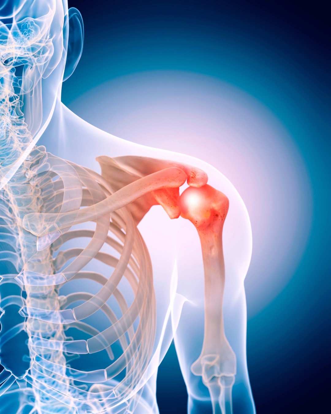 Shoulder Replacement